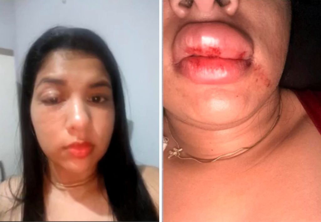 Ex-namorada denuncia vereador por agressão no TO: ‘Abriu a porta e começou a me socar’